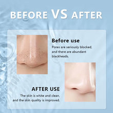 Load image into Gallery viewer, Electric Black Head Instrument Acne Removal Machine Tool Pore Cleaner Vacuum Blackhead Remover