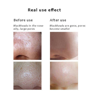 Professional Blackhead Remover Vacuum Acne Pimple Black Spot Suction Electric Facial Pore Cleaner Skincare Exfoliating Beauty