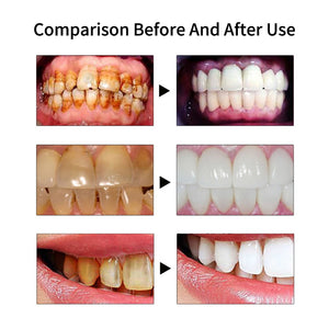 Ultrasonic Dental Scaler Electric Teeth Cleaner Calculus Remover Tartar Eliminator Toothpicks Teeth Whitening Dentistry Tools